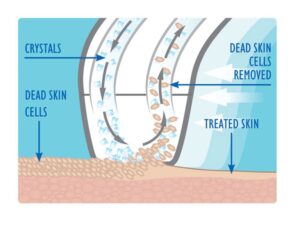 maquina microdermabrasion rio crystalrenew frontal
